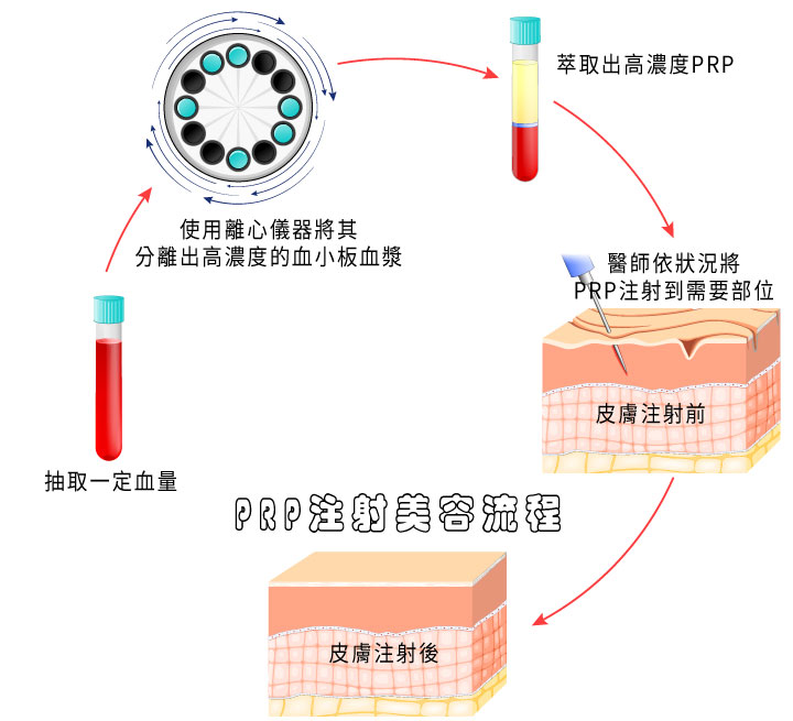 PRP自體生長因子製備流程