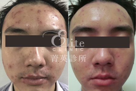 痘疤治療,雷射合併PRP注射,改善痘疤縮小毛孔